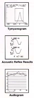 tympanogram